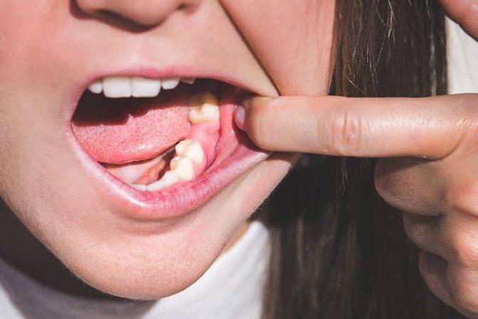 What Happens If You Need a Tooth Extraction but Have an Infection? | Articles | Valley Dental & Orthodontics | Gan Jing World - Technology for Humanity | Video & Movie Streaming