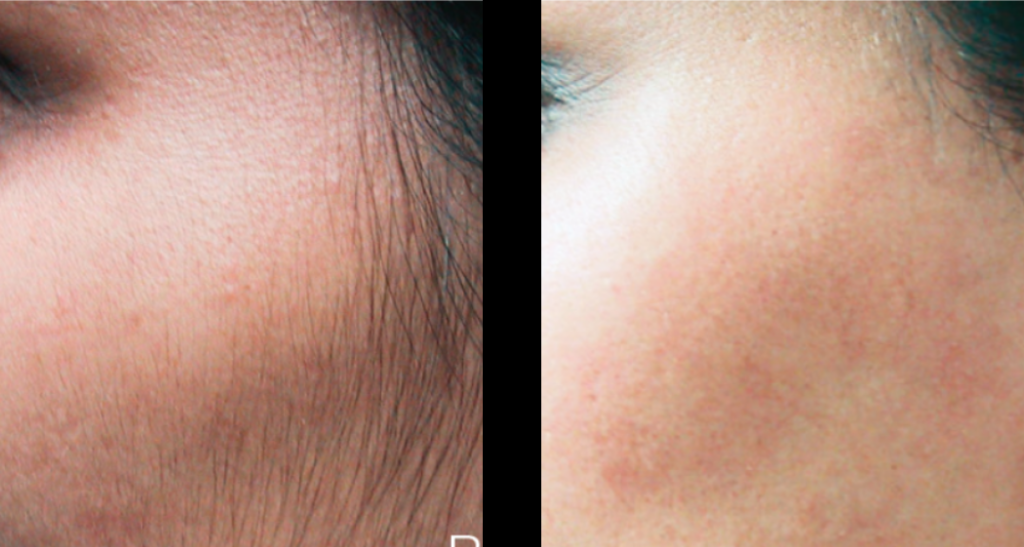 Face Laser Hair Reduction Zirakpur | Mahendra Hair and Skin